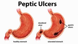 peptic ulcer disease